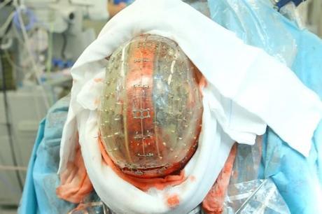 Neurocirujanos implantan un cráneo impreso en 3D con éxito
