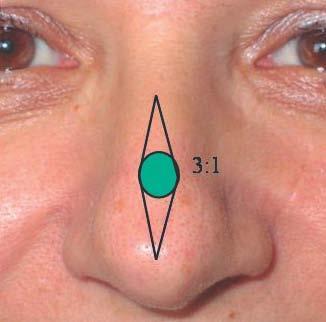 Reconstrucción Nasal con Cartílago Transgenico