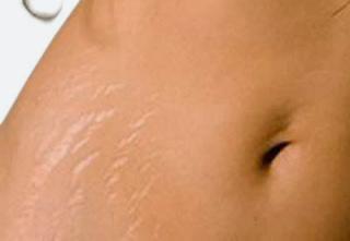 ¿Piel de cebra? Como combatir las odiosas estrías