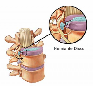 hernia de disco