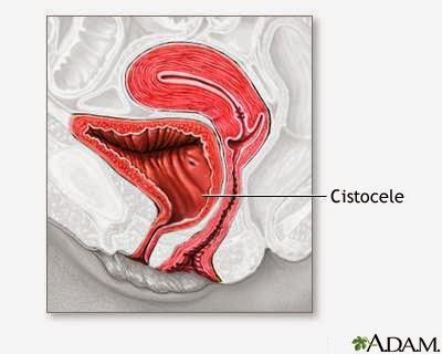 Admito que a veces ¡Se me sale! Afrontar la Incontinencia Femenina.