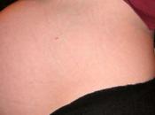 hipertensión crónica incrementa problemas embarazo