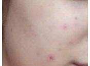 Vuelvo Lullage: Lullage acneXpert