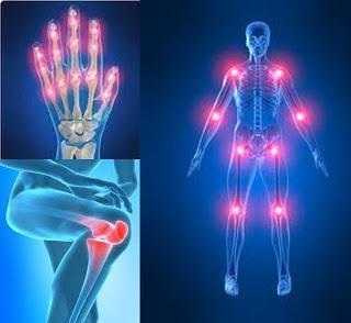 Aparato Implantado Controla la Artritis ReumatoideEn las ...