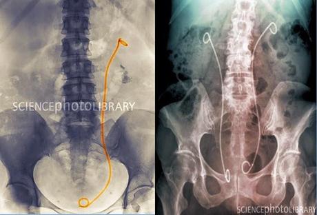 Tres imagenes de rayos X de portadores de catéteres doble J