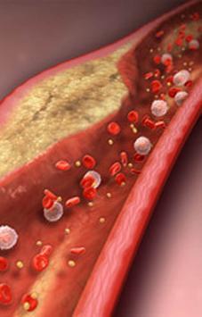 Nuevo fármaco podría eliminar el colesterol de las arterias