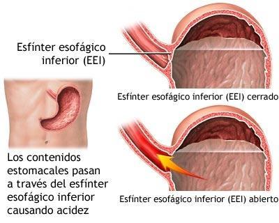 El ardor de estómago en el programa del doctor Oz. Acidez estomacal El ardor de estómago en el programa del doctor Oz. Acidez estomacal
