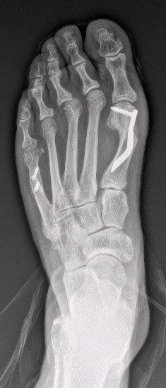 TRATAMIENTO QUIRURGICO DEL LLAMADO PIE TRIANGULAR