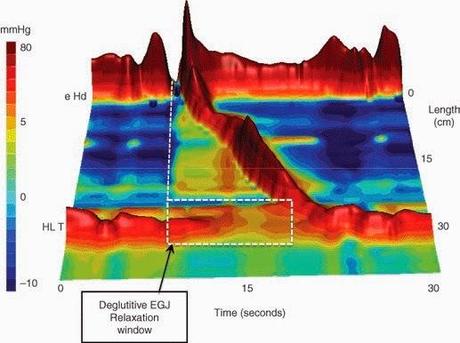 DIGESTIVO: Manométrica Esofágica de Alta resolución desplaza a Manometría convencional