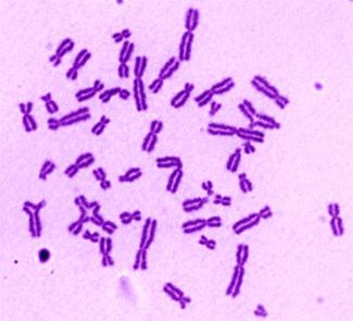 25 AÑOS DEL PRIMER TRANSPLANTE DE SANGRE CORDÓN UMBILICAL