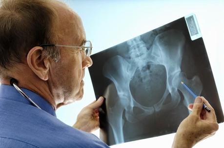 Nutre tus huesos: ¡OJO CON LA OSTEOPOROSIS!