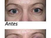 Blefaroplastia