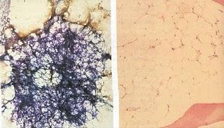 Trasplante de médula ósea, opción curativa para leucemias y anemia aplásica: IMSS