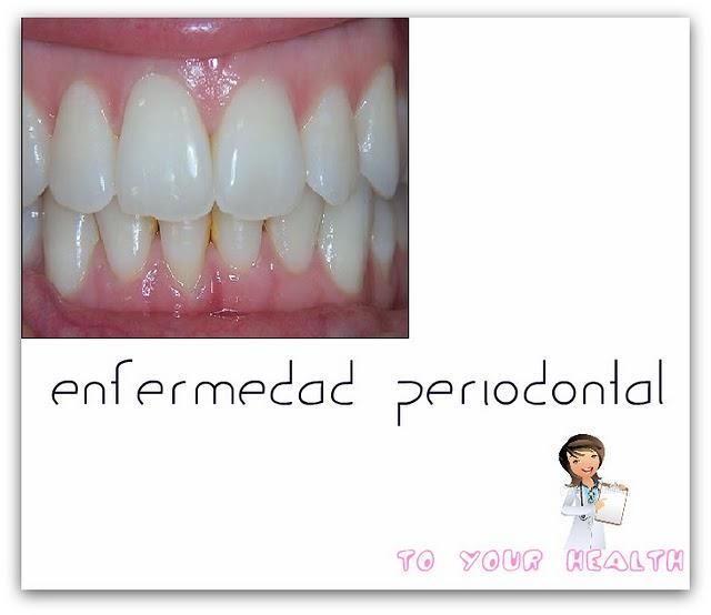 ENFERMEDAD PERIODONTAL