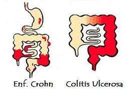 Enfermedad Inflamatoria Intestinal