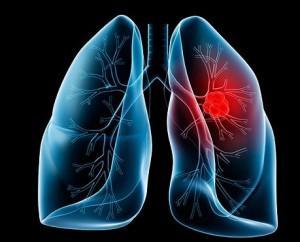 Primera vacuna terapéutica contra el cáncer de pulmón Racotumomab, Vacuna Argentino-Cubana