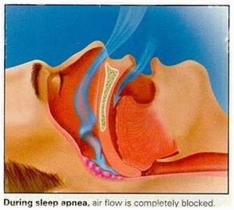 Síndrome de apneas-hipopneas del sueño