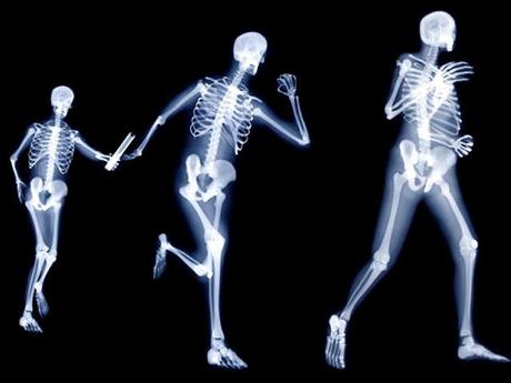 osteop45 Prevenir la osteoporosis desde la juventud