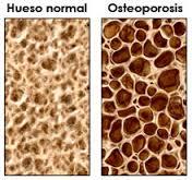 osteopor2 Prevenir la osteoporosis desde la juventud