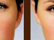 Botox entrecejo: cómo conseguir resultado natural