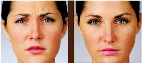 BOTOX EN ENTRECEJO: CÓMO CONSEGUIR UN RESULTADO NATURAL
