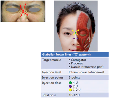 BOTOX EN ENTRECEJO: CÓMO CONSEGUIR UN RESULTADO NATURAL