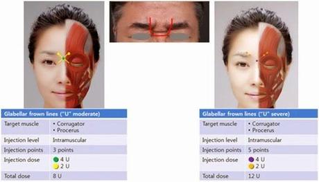 BOTOX EN ENTRECEJO: CÓMO CONSEGUIR UN RESULTADO NATURAL