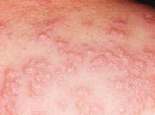 Dermatosis Febril Aguda