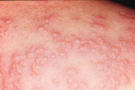 La Dermatosis Febril Aguda
