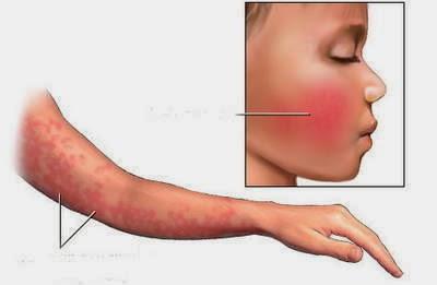 Fruta y polen, ¿alergia compartida?