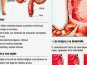 Cómo afecta cáncer colon #Infografía #Salud #Cáncer