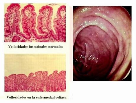 Novedades sobre la Enfermedad Celíaca