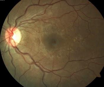 Mirando la retina…llegamos hasta el riñón (por el Dr. Álvaro De Casas - Oftalmólogo)