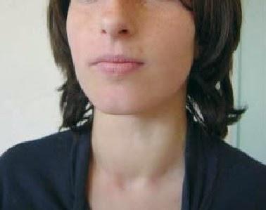 DIETAS PARA EL HIPOTIROIDISMO