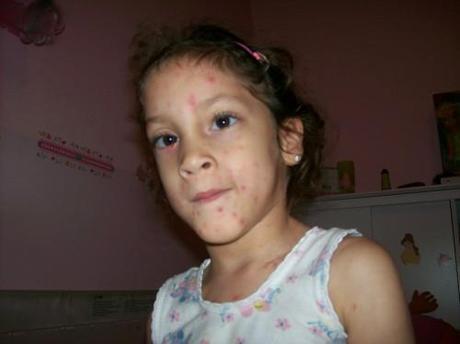 Los casos de varicela han aumentado en España por el bloqueo de la vacuna vacunación contra la varicela