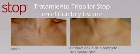 Radiofrecuencia facial, con Tripollar Stop