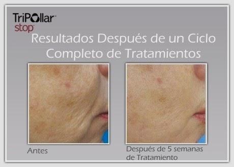 Radiofrecuencia facial, con Tripollar Stop