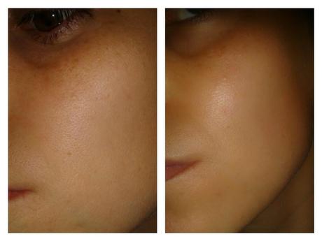 Radiofrecuencia facial, con Tripollar Stop