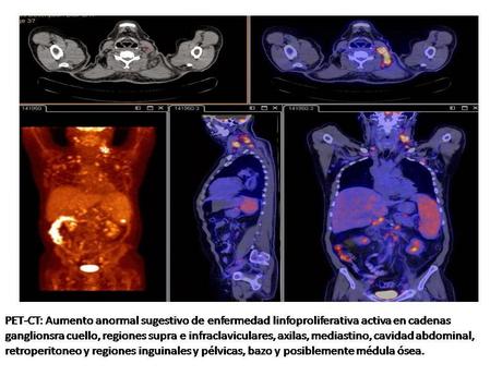 Valoración del paciente con esplenomegalia