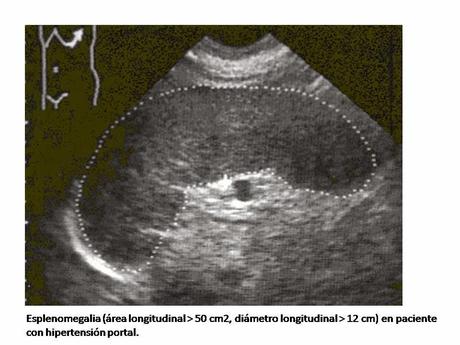 Valoración del paciente con esplenomegalia