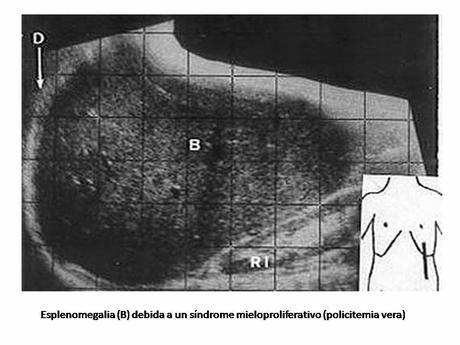 Valoración del paciente con esplenomegalia