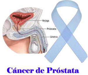 Cáncer de próstata Alternativas para la Prevención y Tratamiento