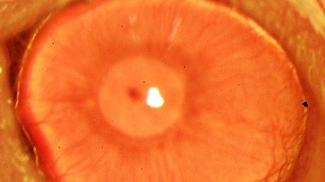 REGENERAN CÓRNEA HUMANA CON CÉLULAS MADRE ADULTAS