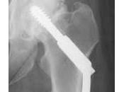 Indicadores preoperatorios mortalidad después cirugía fractura cadera. Revisión sistemática metaanálisis.