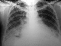 Se retransmite la primera operación en España para el tratamiento percutáneo de la insuficiencia mitral