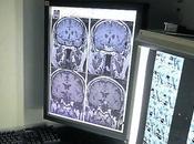 Crearon analisis sangre puede predecir Alzheimer.