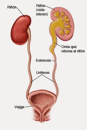 Testimonio del padecimiento de una chica con estenosis ureteral