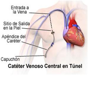 catetercentral