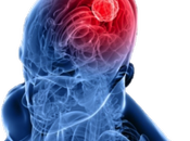 radioterapia Cáncer Sistema Nervioso Central