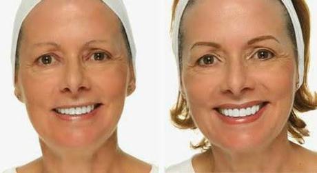 Que hacer ante el adelgazamiento o pérdida de cejas